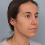 rhinoplasty-after-2