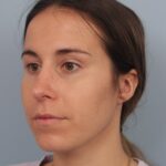 rhinoplasty-after-3