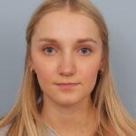 rhinoplasty-after-5
