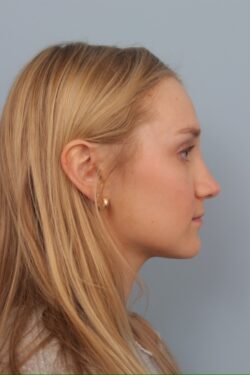 after rhinoplasty