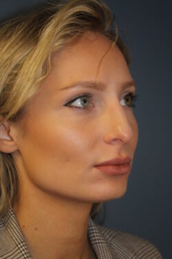 before rhinoplasty