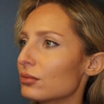 rhinoplasty-before-13