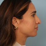 rhinoplasty-before-14