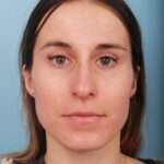 rhinoplasty-before