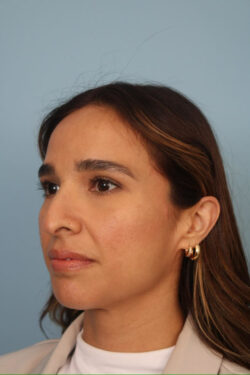 before rhinoplasty