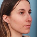 rhinoplasty-before-2