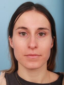 before rhinoplasty