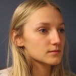 rhinoplasty-before-6