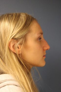 before rhinoplasty