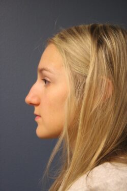 before rhinoplasty
