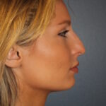 rhinoplasty-before-9