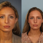rhinoplasty-merged-11
