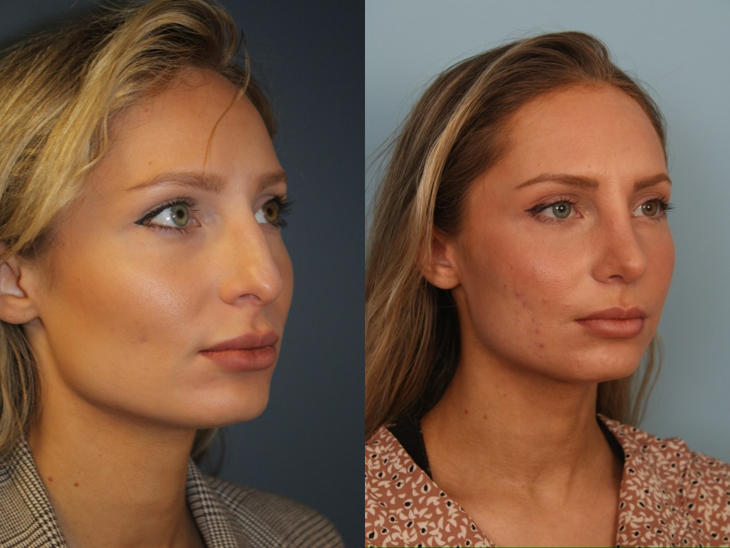 before_after_img
