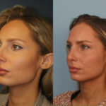 rhinoplasty-merged-13