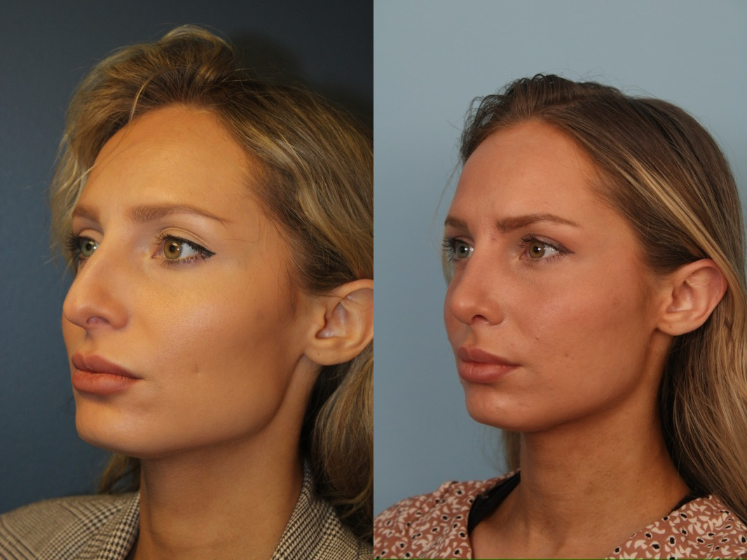before_after_img
