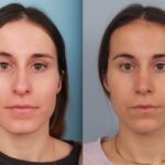 rhinoplasty-merged