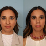 rhinoplasty-merged-16