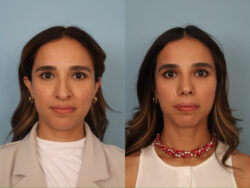 before and after rhinoplasty