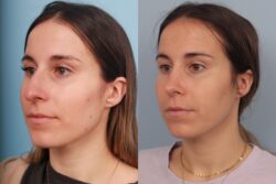before and after rhinoplasty