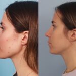 rhinoplasty-merged-4