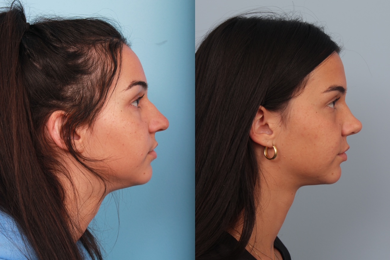 before_after_img