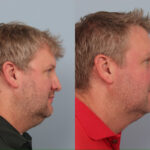 revision-rhinoplasty-merged