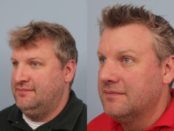 before and after revision rhinoplasty