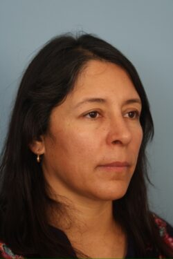 after rhinoplasty