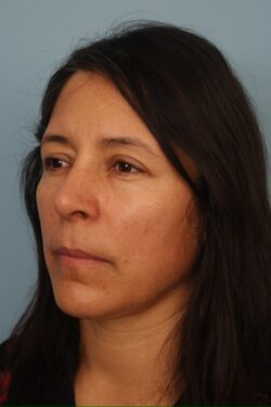 after rhinoplasty