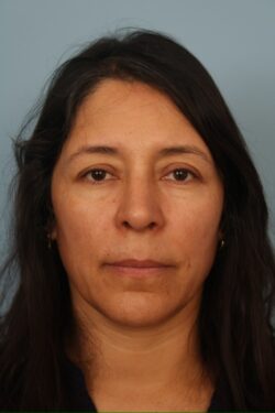 after rhinoplasty