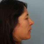 rhinoplasty-after