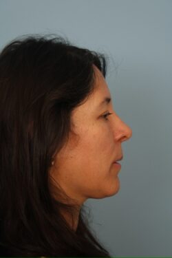 after rhinoplasty