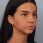 rhinoplasty-after