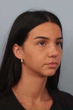 after rhinoplasty