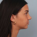 rhinoplasty-after