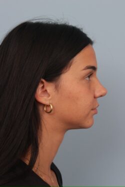 after rhinoplasty