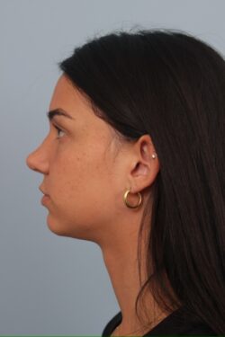 after rhinoplasty