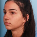 rhinoplasty-before