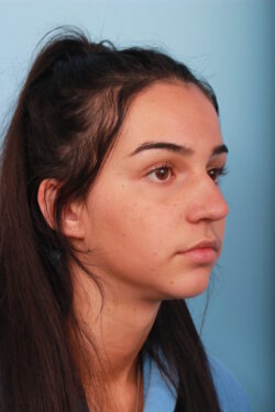 before rhinoplasty