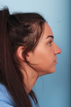 before rhinoplasty