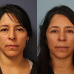 rhinoplasty-merged
