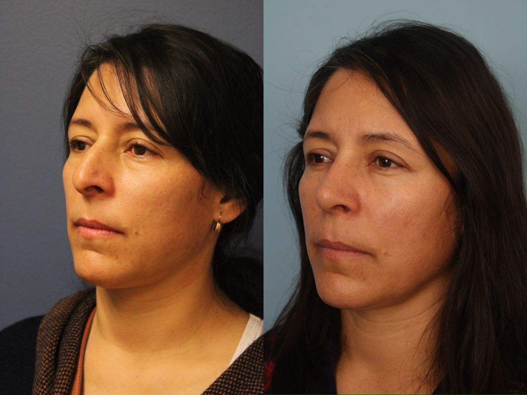 before_after_img
