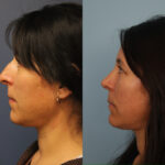 rhinoplasty-merged