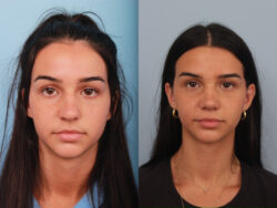 before and after rhinoplasty