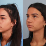 rhinoplasty-merged