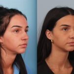 rhinoplasty-merged