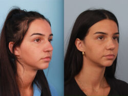 before and after rhinoplasty