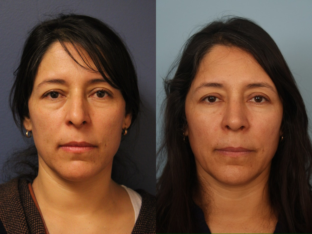 before_after_img