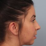 rhinoplasty-after