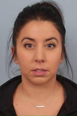 after rhinoplasty